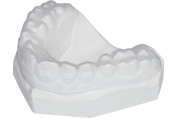 Brackettransfer-, Ätzmasken